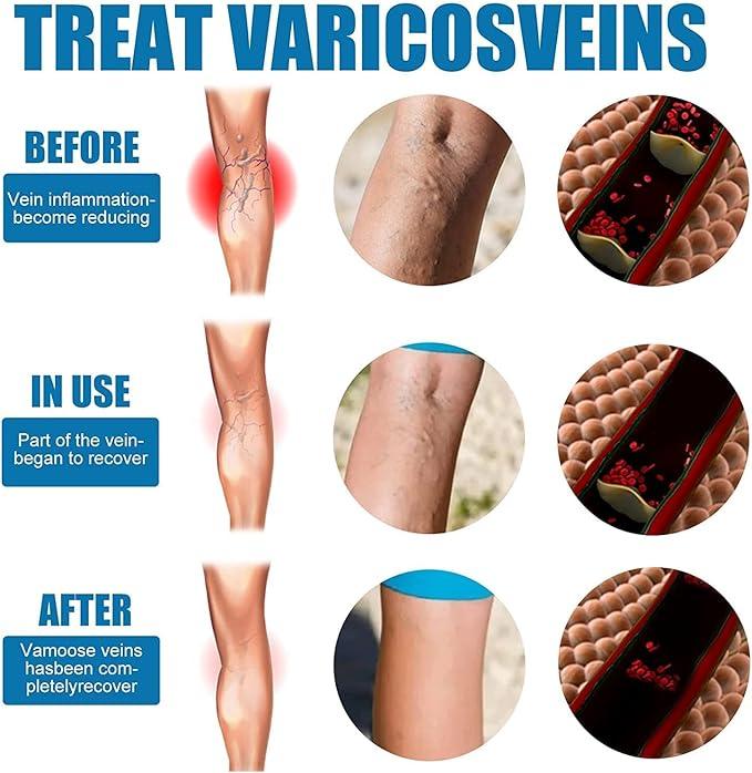 Varicose Veins Treatment Big Mart