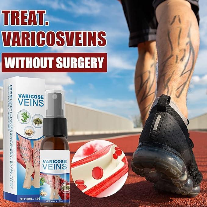 Varicose Veins Treatment Big Mart
