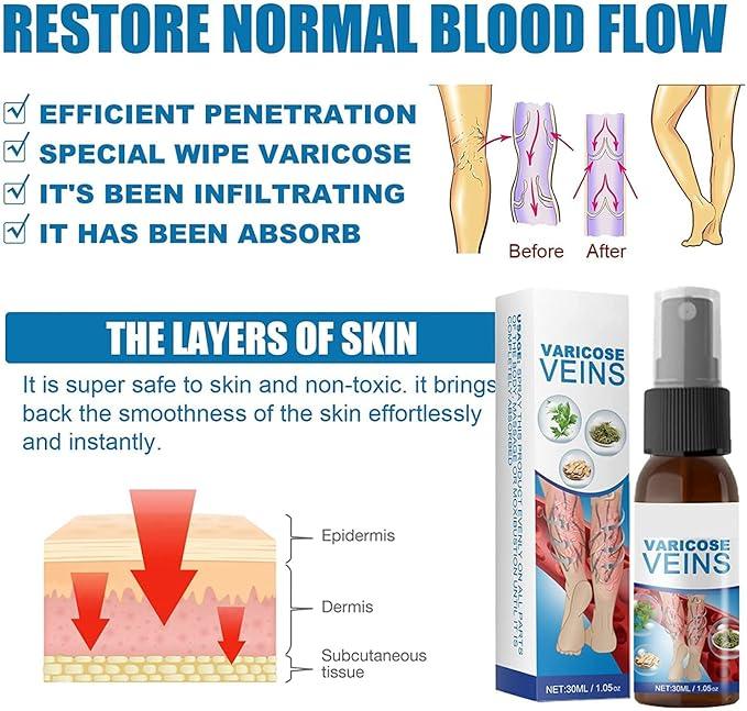 Varicose Veins Treatment Big Mart
