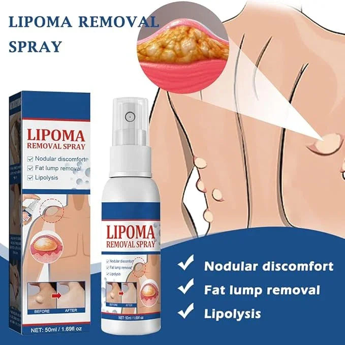 LIPOMA REMOVAL SPRAY (IMPORTED) Wise deal